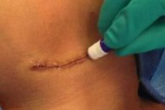 Skin glue (sutureless) closure of surgical incisions